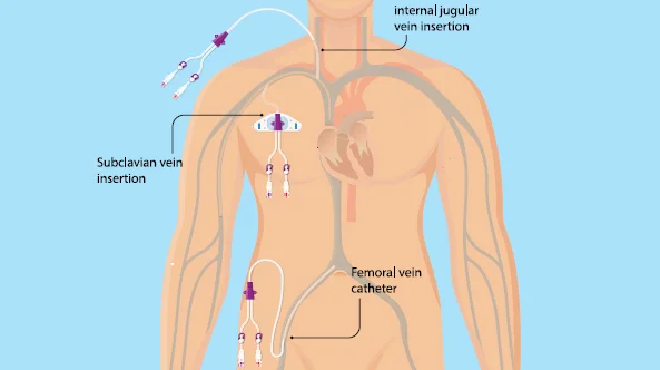 catheter insertion in Aurangabad