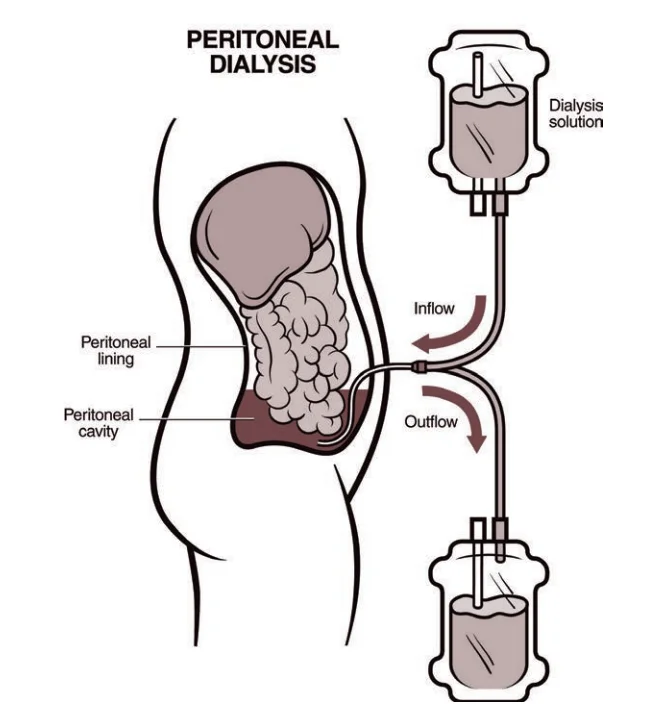 peritoneal-dialysis-in-aurangabad