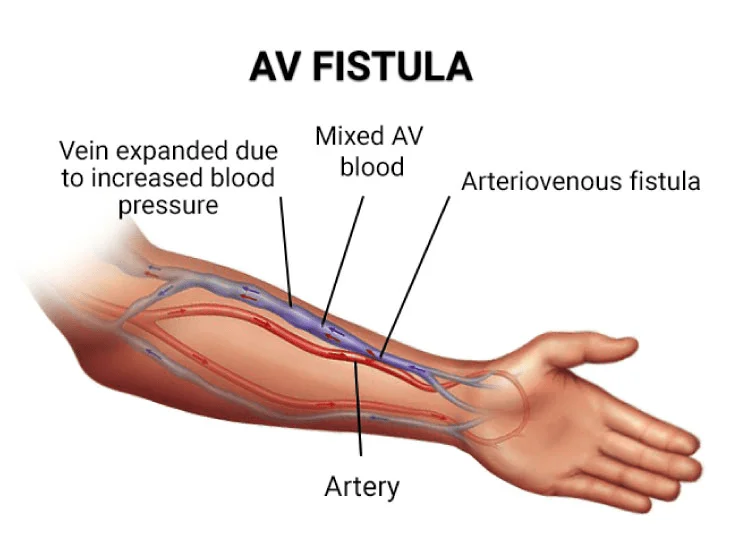 AV fistula