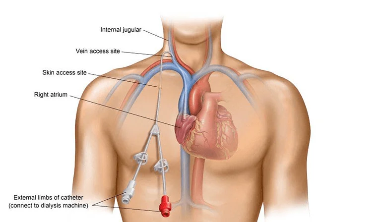 acute hemodialysis in Aurangabad